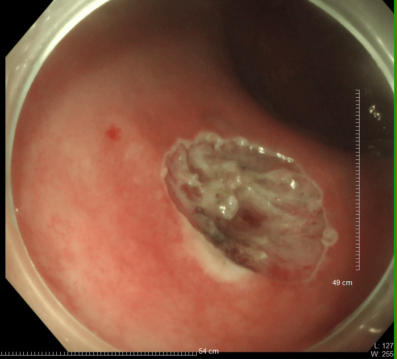 發現早期腸道腫瘤，胃腸鏡檢查很有必要