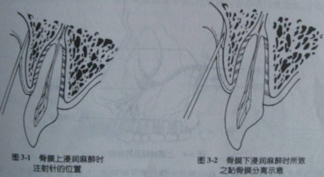 牙科必懂的口腔區域性麻醉