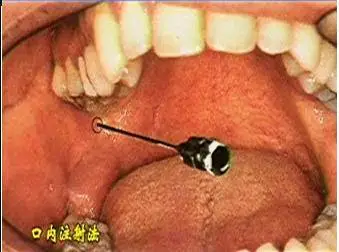 牙科必懂的口腔區域性麻醉